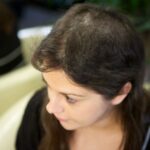 ocd and hair pulling